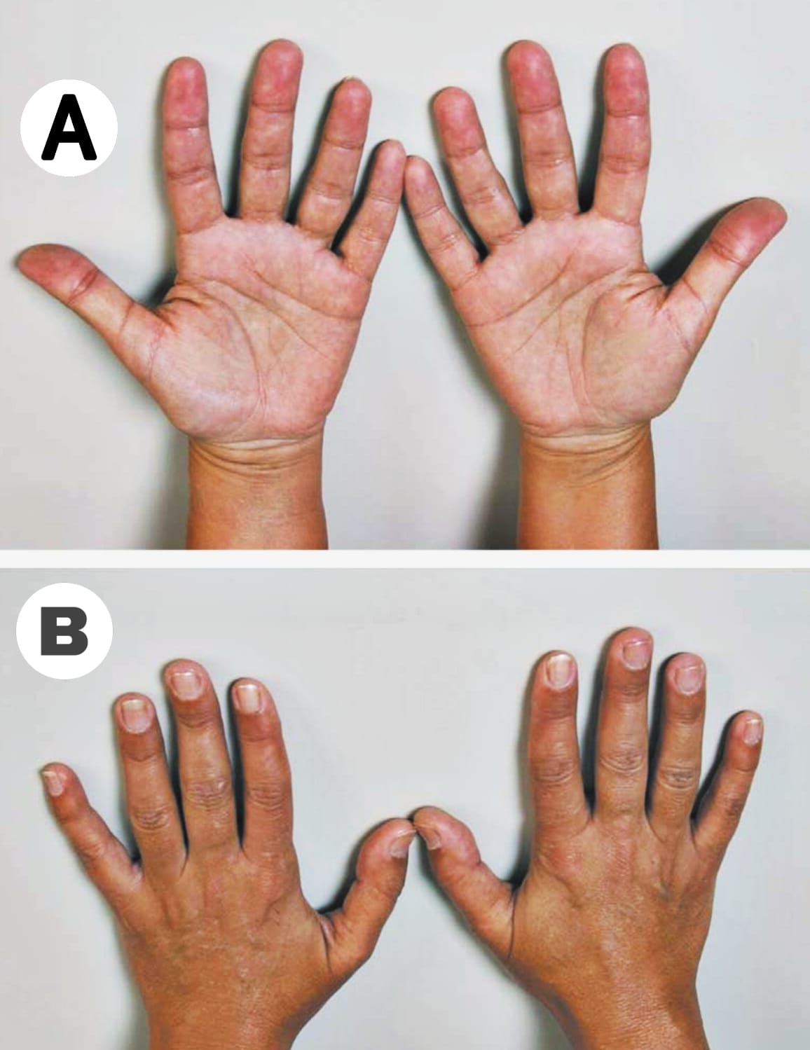 Is Addison's Disease Really a Lifelong Condition?